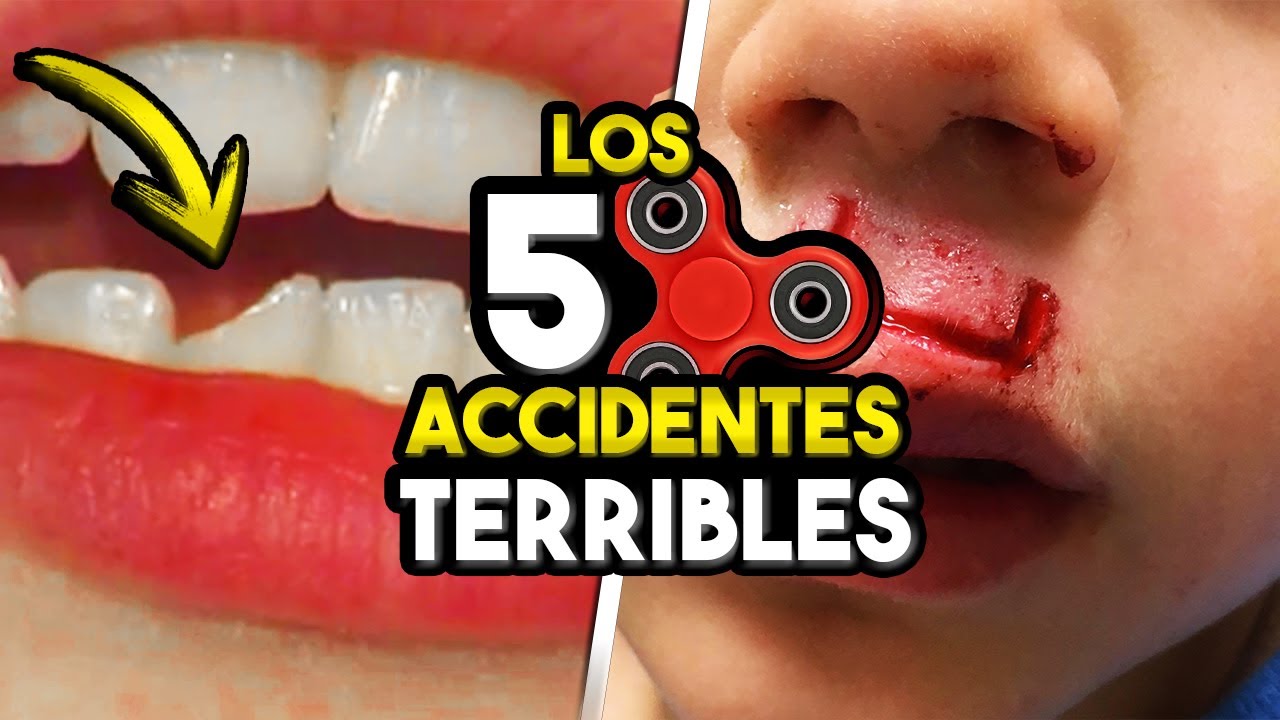 5 ACCIDENTES TERRIBLES QUE DEJARON LOS FIDGET SPINNERS