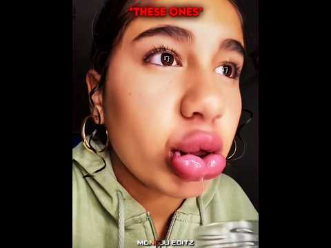 Lip Filler Prank 💋🤣