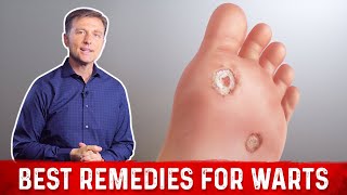 4 Best Wart Removal Remedies – Dr. Berg on Wart Treatment at Home
