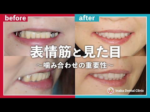 表情筋と見た目：噛み合わせの重要性
