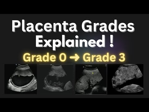 Placenta Grading Explained: Grade 0 to Grade 3 with Real Ultrasound Images