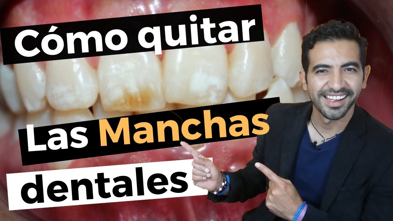 Así elimino las manchas en los dientes. CASO DE ÉXITO