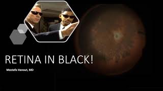 Retina in Black!! Vitreous metastasis of cutaneous melanoma.