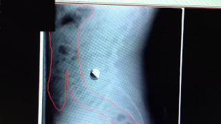 Constipation (Poop) on X Ray | Dr. Alan Nathans