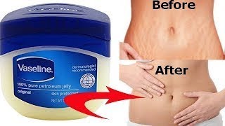 How To Get Rid of Stretch Marks Fast | Natural Remedies for Stretch Mark Removal