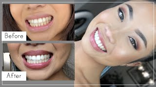 Teeth Whitening At Home With Hydrogren Peroxide 3%