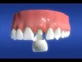 Dental Crowns