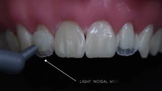 Peg Laterals Restorations with  Rhodri Thomas, BDS