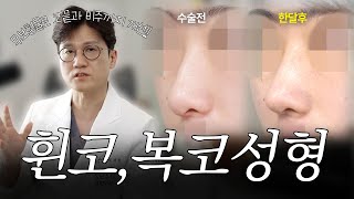 처지고 각진 비주, 그리고 휜코+복코 해결! 남자 무보형물 코성형 1개월 경과 케이스리뷰