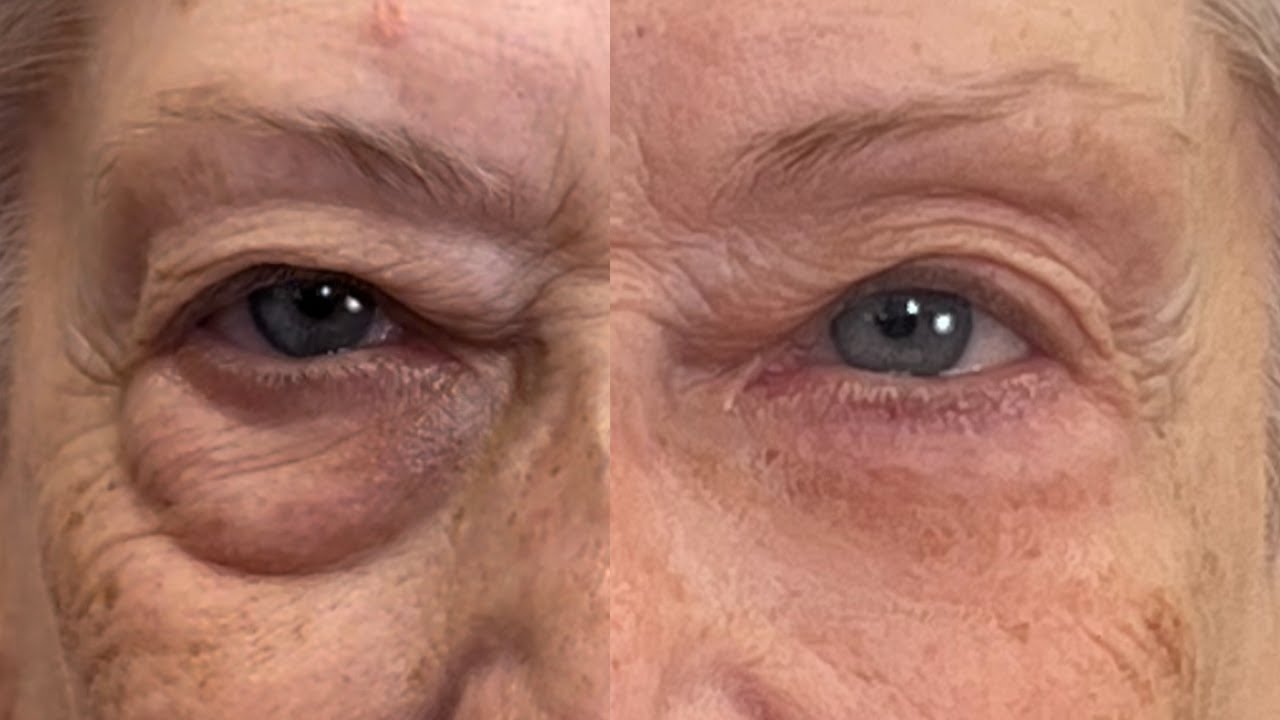 Get Rid of Eye Bags Instantly (Eliminate Puffiness and Darkness) 🚨 Fierce Aging with Nikol Johnson