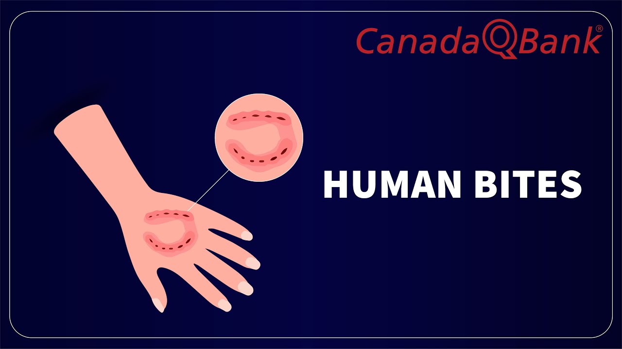 Human Bites: Infection Risk, Treatment & When to Worry | Emergency Medicine | CanadaQBank