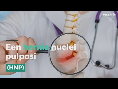 Een hernia nuclei pulposi (HNP)