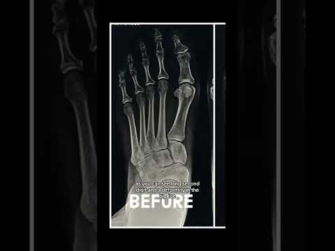 Toe SHORTENING & Crooked Big Toe Repair!