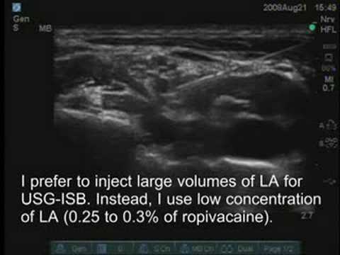 Ultrasound-Guided Interscalene Brachial Plexus Block
