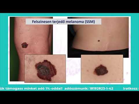 parazita kezelési tapasztalat