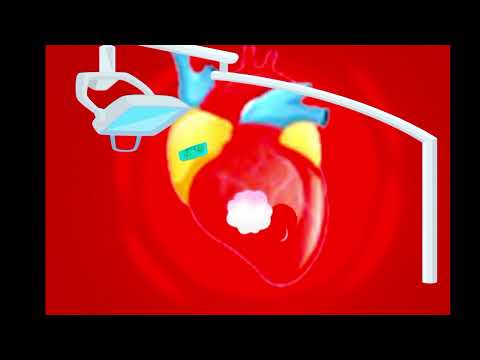How Does Heart Surgery Work? Coronary Artery Graft Procedure Animation - CABG Video life care tv1