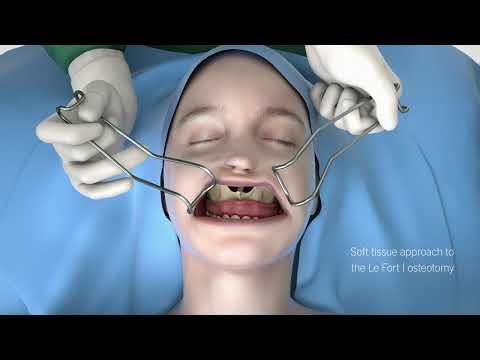 IPS® Distraction - The future of distraction osteogenesis - 2025