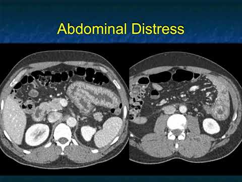 CT Evaluation of Small Bowel Obstruction - Part 5