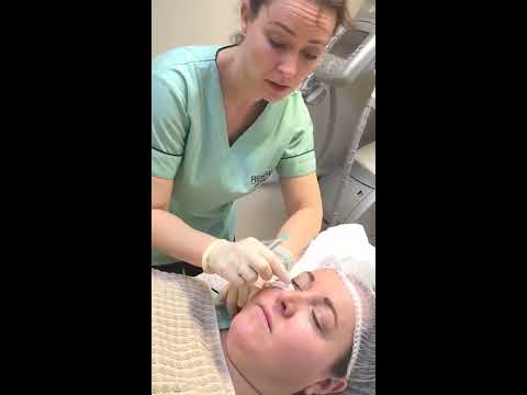 Decolorazione della persona in Ekaterinburg Peeling di una faccia da lentiggini