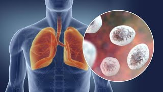 Epidemiology of Pneumocystis Pneumonia