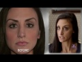 Gorgeous Revision Rhinoplasty Results