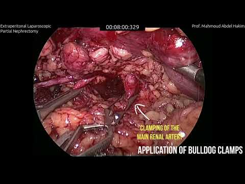 استئصال الكلية الجزئي بالمنظار: Trans vs Retroperitoneal