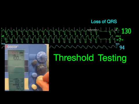 Temporary pacemakers 101: Output/stimulation