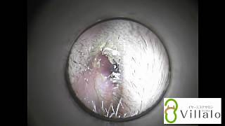 耳掃除動画vol.6「耳毛に絡まった耳垢」