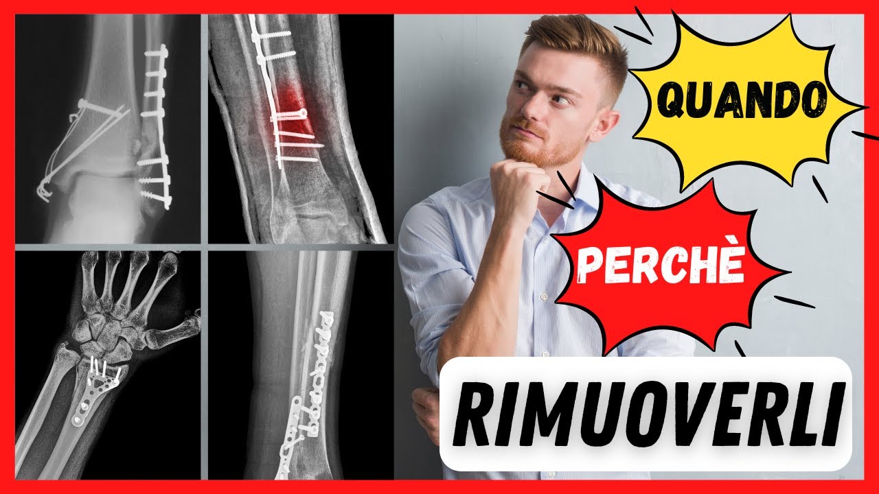 Watch Now 🟡 Quando rimuovere placca e viti | è davvero sempre necessario rimuoverli❓❓ 🟡 Quando rimuovere placca e viti | è davvero sempre necessario rimuoverli❓❓