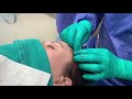 Lateral 1/3 Of Eyebrow
