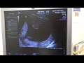 Kyle Lindsey Baby Dec 2013