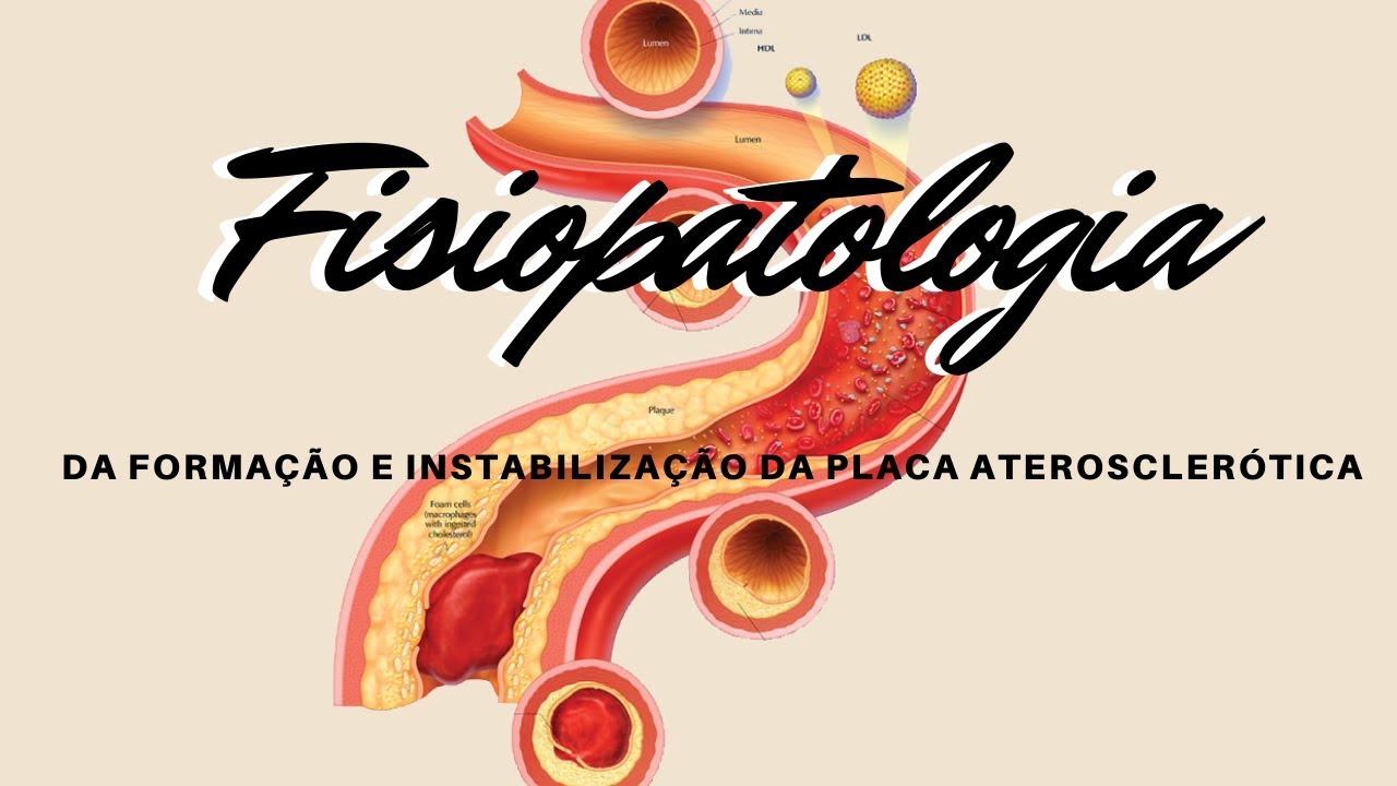 Fisiopatologia da formação e instabilização da placa aterosclerótica