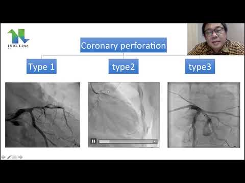 Complication During PCI