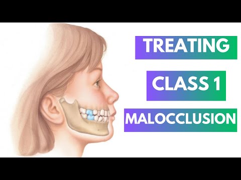 Management of Class 1 Malocclusion -Orthodontics