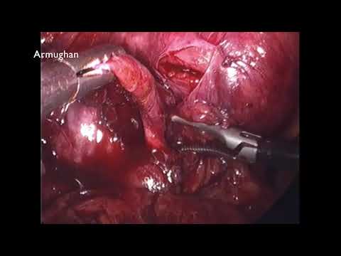 Completion Laparoscopic Cholecystectomy Video
