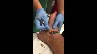 Open Severe Compound Fracture Wound - Necrotic Skin Removal