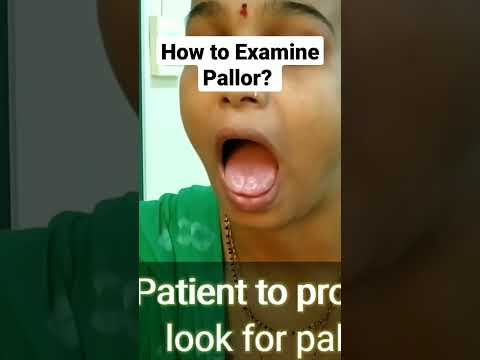 How to look for Anemia #mbbs #neet