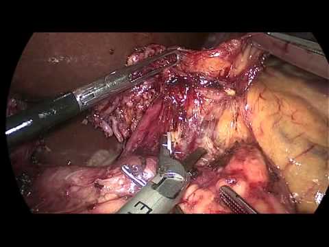 Laparoscopic Distal Gastrectomy With D2 Dissection In Advanced Gastric Cancer