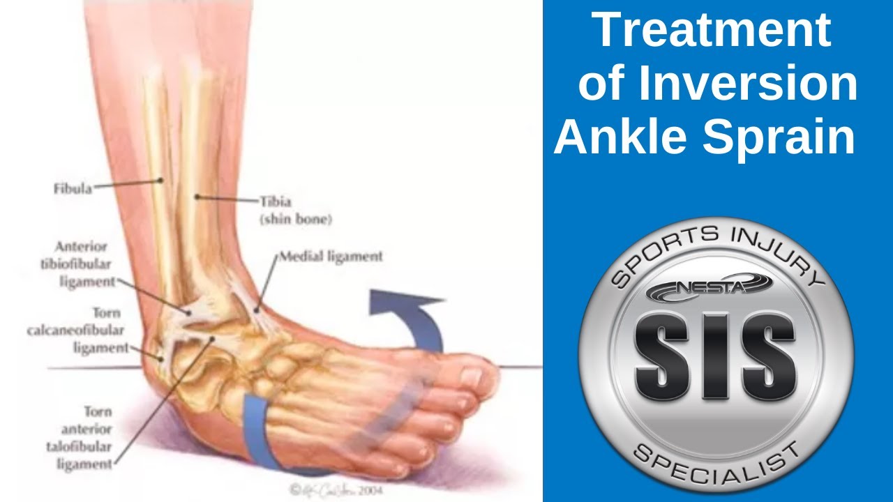 Inversion Ankle Sprain Treatment