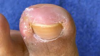Ep_8748 Ingrown toenail removal 👣 นี่ไง..ที่มันแทงหนู 😅 (clip from Thailand)