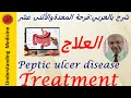 PEPTIC ULCER DISEASE PUD MANAGEMENT شرح بالعربي:قرحة المعدة والأثنى عشر _العلاج