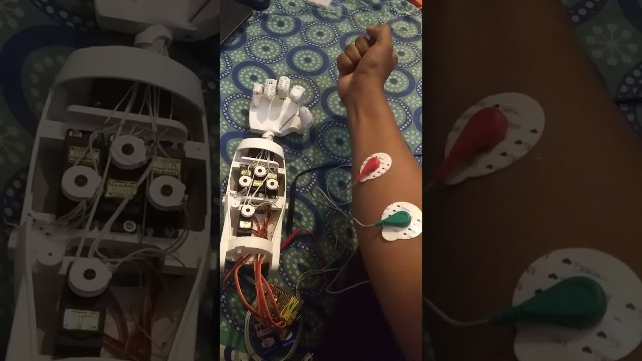 3D printed Robotic Prosthetic Arm