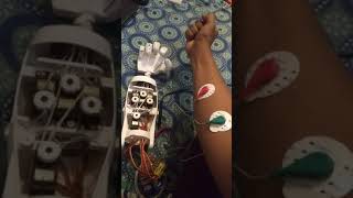 3D printed Robotic Prosthetic Arm