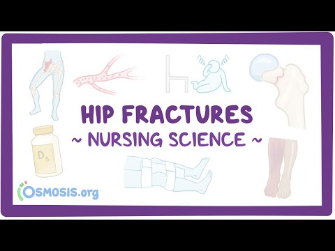 Hip fractures: Clinical Nursing Care
