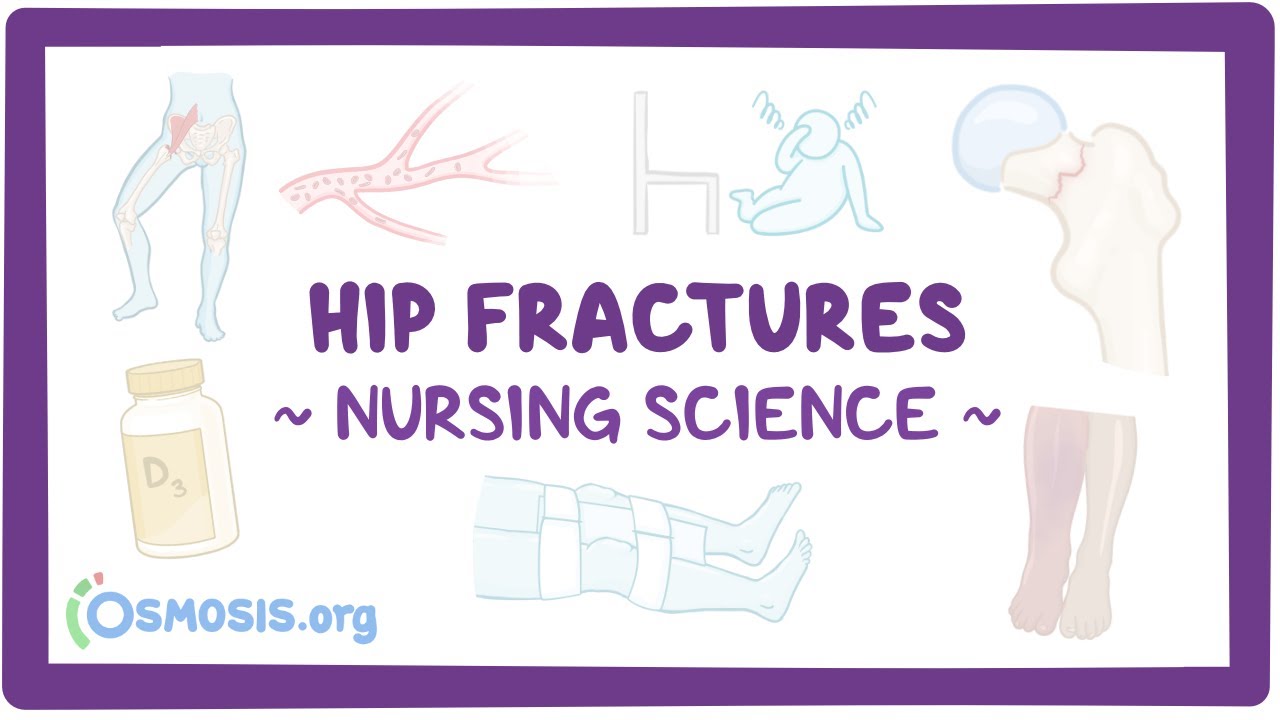 Hip fractures: Clinical Nursing Care