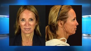 Could a Micro Neck Lift Be Right for You?