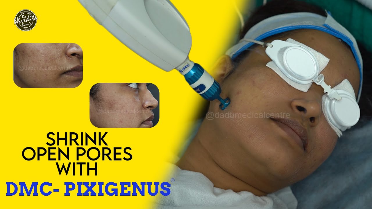Shrink Open Pores