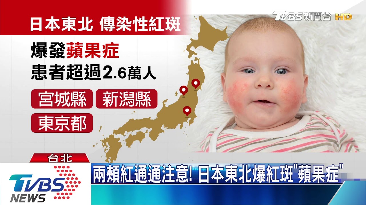國內流感發威出國也要小心　「日本蘋果症、韓麻疹」橫行