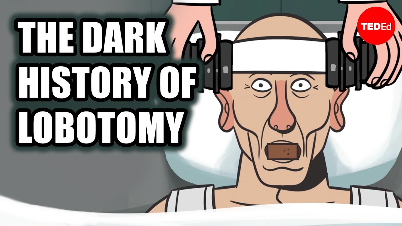 The Dark Legacy of Lobotomy: A Controversial Chapter in Medical History ...