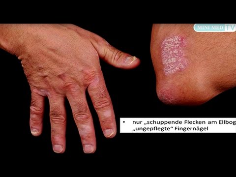 Die Medikamente vom Ekzem auf den Händen nicht hormonal Ob die Schuppenflechte bei der Schwangerschaft gehen kann
